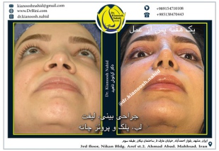 combined-facial-plastic-surgery-4