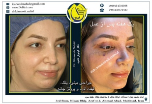 combined-facial-plastic-surgery-6