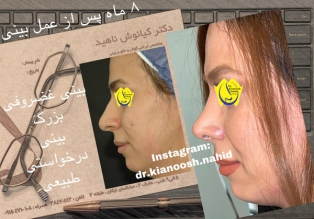 rhinoplasty-before-after-11