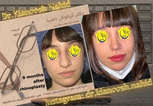 rhinoplasty-before-after-18