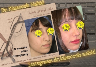 rhinoplasty-before-after-19