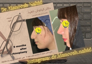 rhinoplasty-before-after-20
