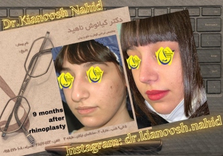 rhinoplasty-before-after-21