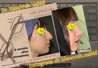 rhinoplasty-before-after-24
