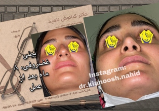 rhinoplasty-before-after-5